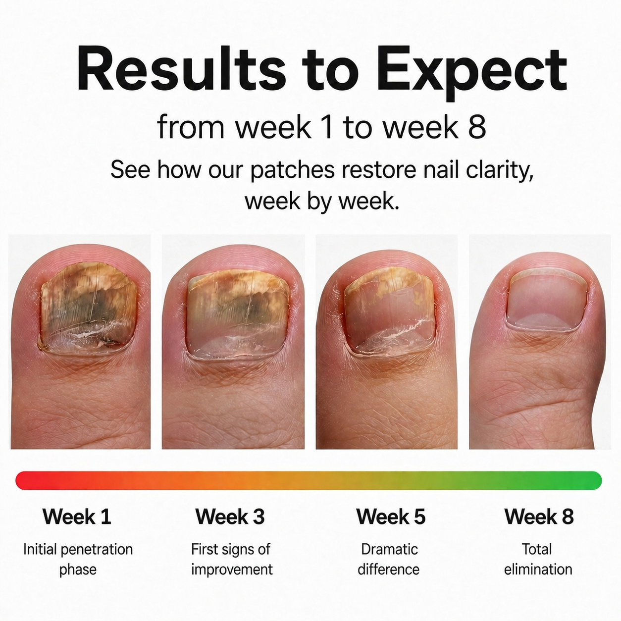 Nurex® Fungal Nail Removal Patches